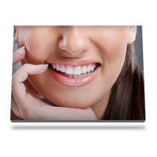 FixBoost-Inlines-Facette-en-porcelaine