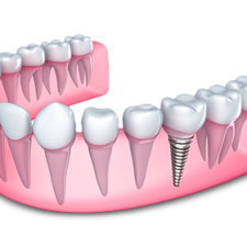 FixBoost-Inlines-implants
